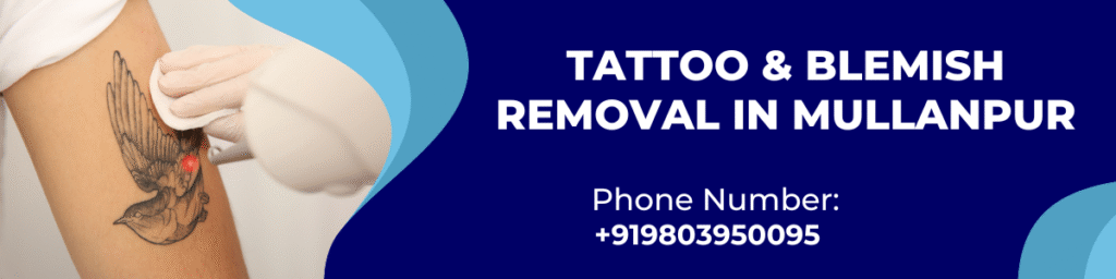 Tattoo & Blemish Removal in Mullanpur